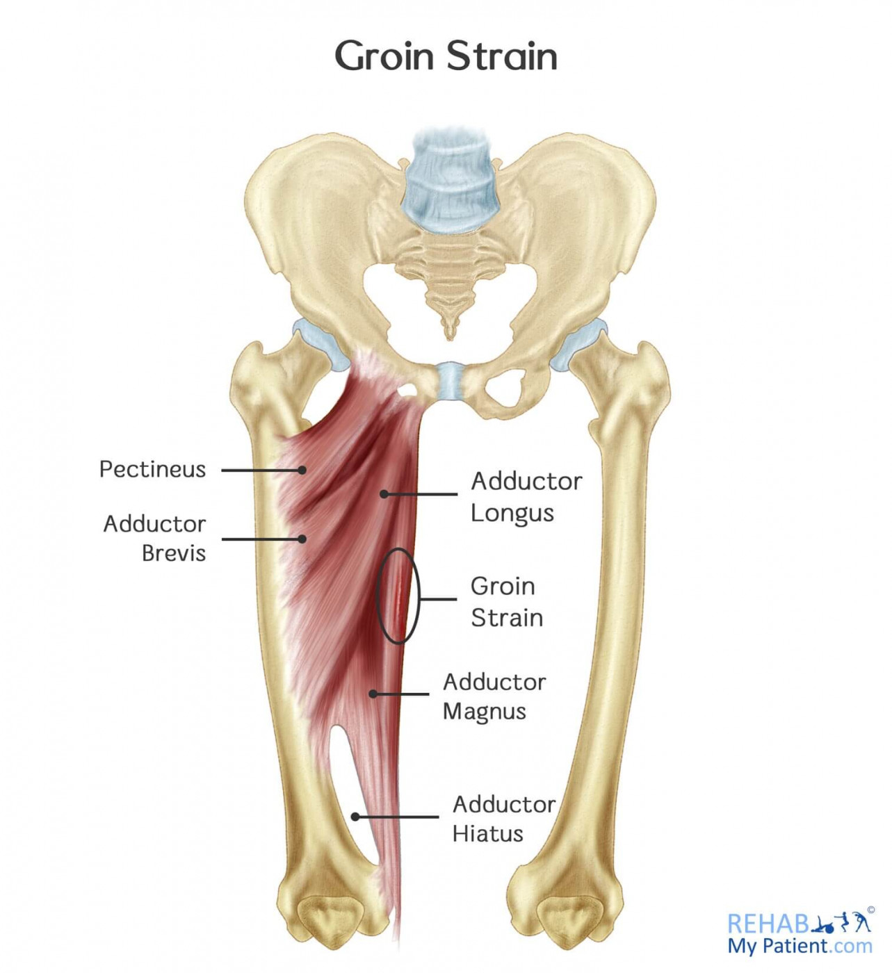 Diagram of muscles affected in groin strain