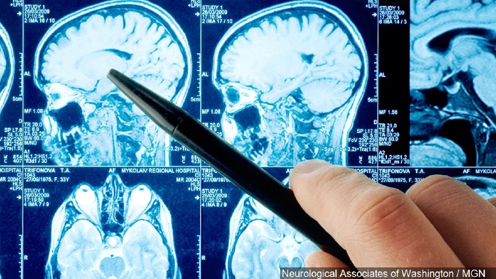 MRI of human brain with concussion