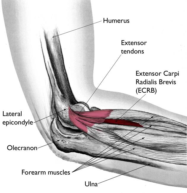 Diagram showing arm with tennis elbow